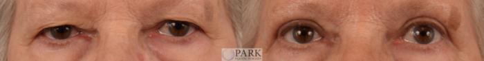 Before & After Blepharoplasty Case 83 Front View in Rocky Mount & Greenville, NC