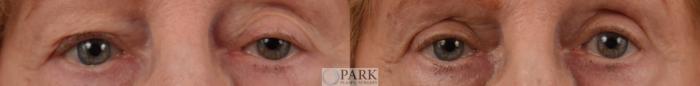 Before & After Blepharoplasty Case 84 Front View in Rocky Mount & Greenville, NC