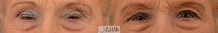 Insurance approved upper blepharoplasty