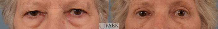 Upper and Lower Blepharoplasty Surgery