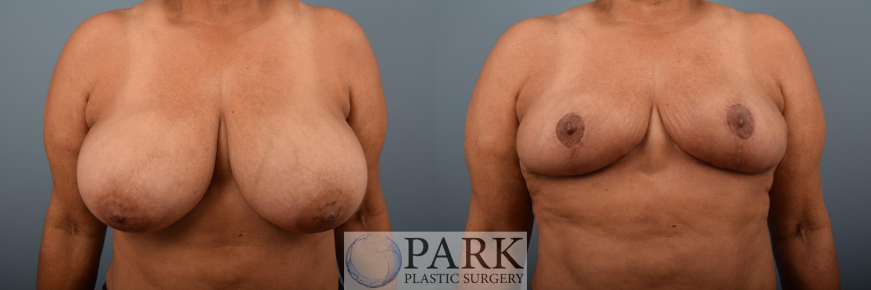 Before & After Breast Reduction Case 79 Front View in Rocky Mount & Greenville, NC