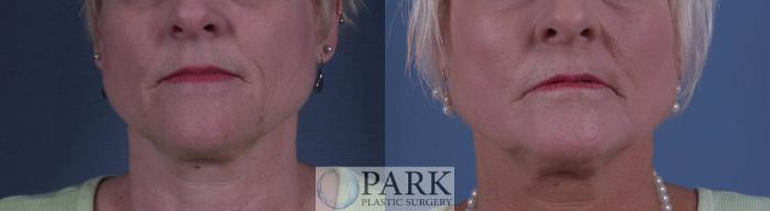 Before & After Laser Skin Resurfacing Case 10 Front View in Rocky Mount & Greenville, NC