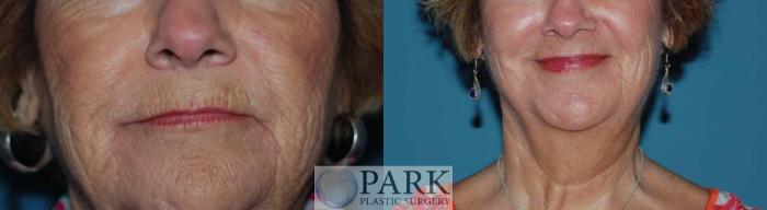 Before & After Laser Skin Resurfacing Case 12 Front View in Rocky Mount & Greenville, NC