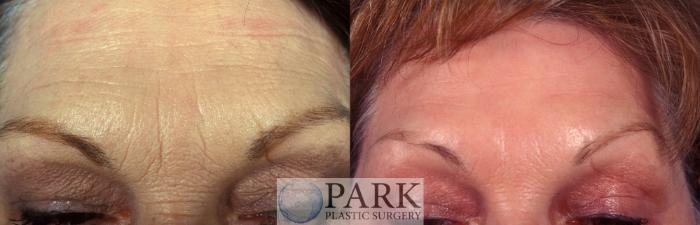 Before & After Laser Skin Resurfacing Case 14 Front Forehead View in Rocky Mount & Greenville, NC