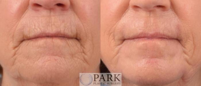Before & After Laser Skin Resurfacing Case 52 Front View in Rocky Mount & Greenville, NC