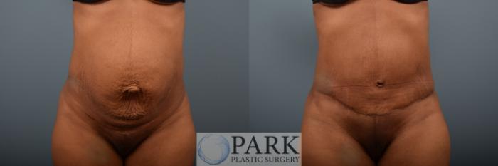 Full Abdominoplasty With Muscle Tightening