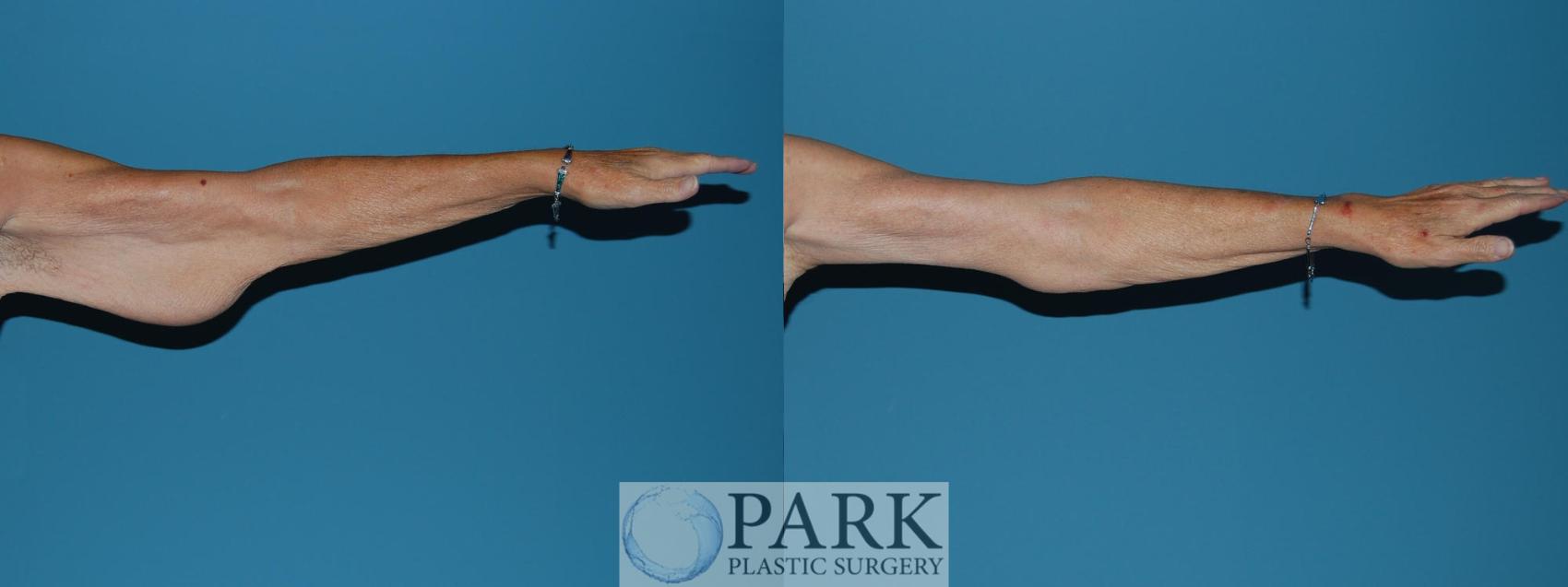 Before & After Arm Lift Case 15 Left Side View in Rocky Mount & Greenville, NC