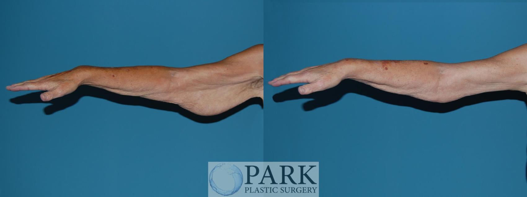 Before & After Arm Lift Case 15 Right Side View in Rocky Mount, NC