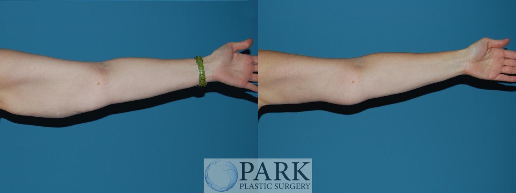 Before & After Arm Lift Case 16 Left Side View in Rocky Mount & Greenville, NC