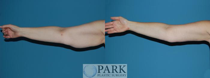 Before & After Arm Lift Case 16 Right Side View in Rocky Mount, NC