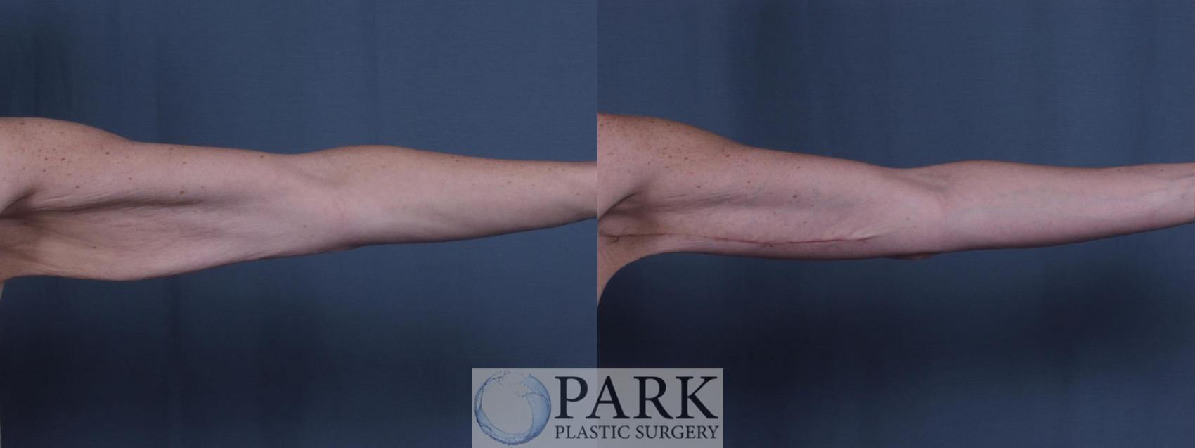 Before & After Arm Lift Case 17 Left Side View in Rocky Mount & Greenville, NC