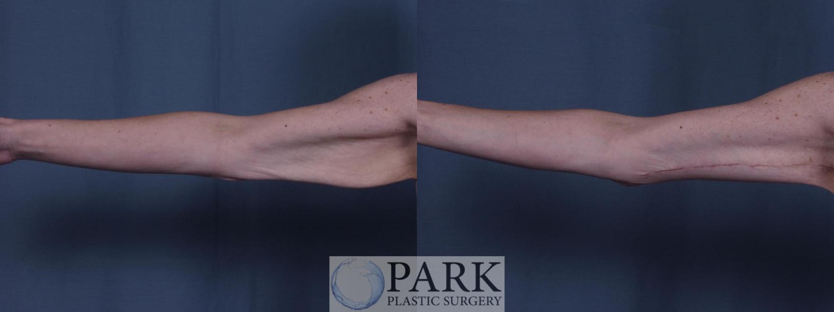 Before & After Arm Lift Case 17 Right Side View in Rocky Mount, NC