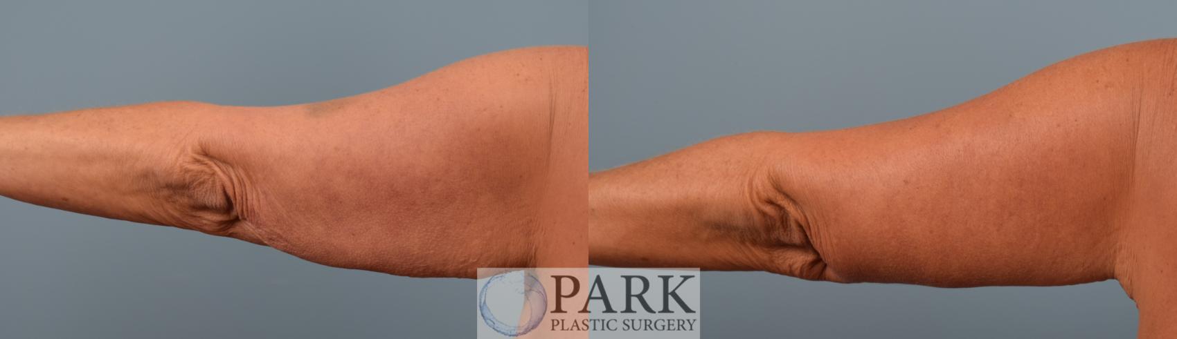 Before & After Arm Lift Case 72 Back View in Rocky Mount & Greenville, NC