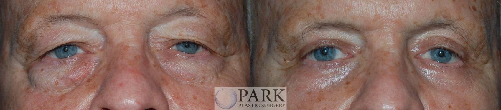 Before & After Blepharoplasty Case 18 Front View in Rocky Mount, NC