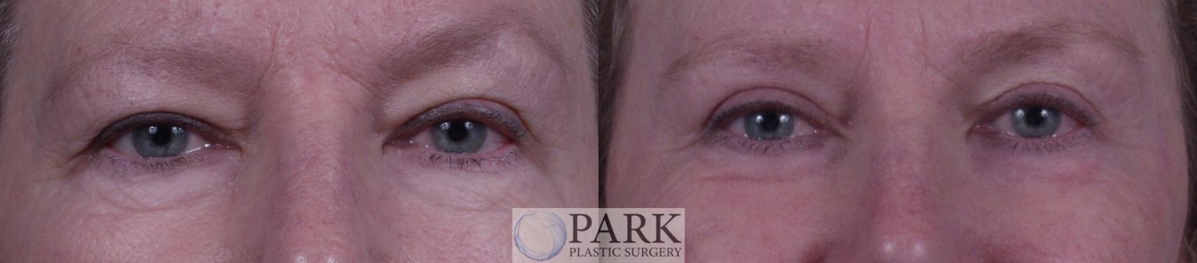 Before & After Blepharoplasty Case 19 Front View in Rocky Mount, NC