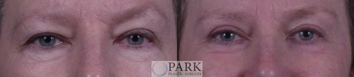 Before & After Blepharoplasty Case 19 Front View in Rocky Mount, NC