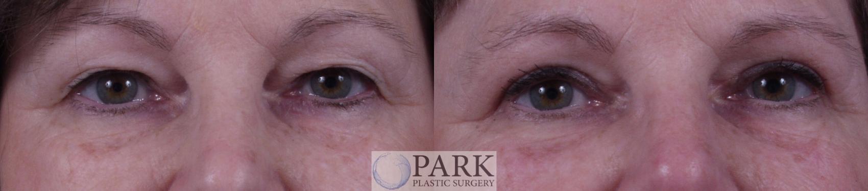 Before & After Blepharoplasty Case 20 Front View in Rocky Mount, NC