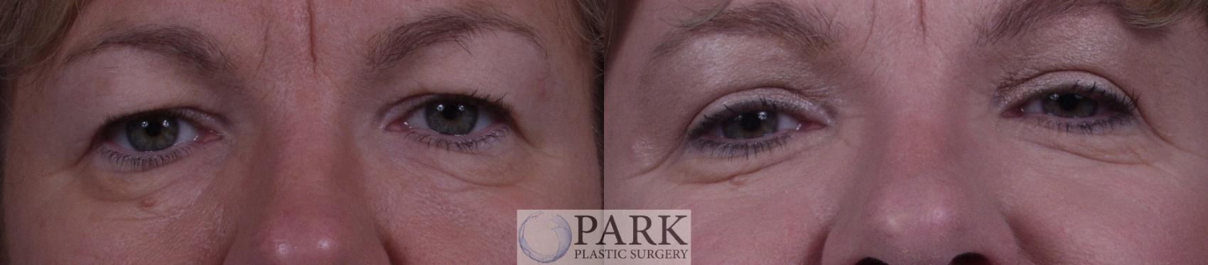 Before & After Blepharoplasty Case 21 Front View in Rocky Mount, NC