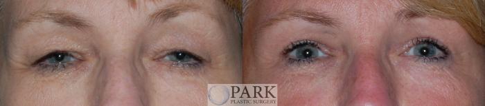 Before & After Blepharoplasty Case 22 Front View in Rocky Mount, NC