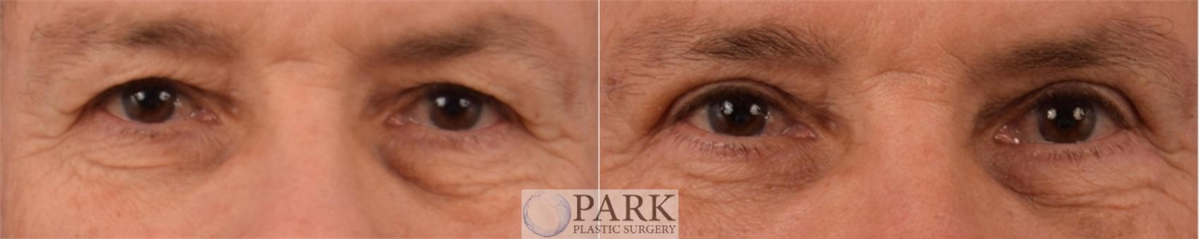 Before & After Blepharoplasty Case 58 Front View in Rocky Mount, NC
