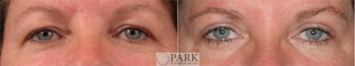 Before & After Blepharoplasty Case 59 Front View in Rocky Mount, NC