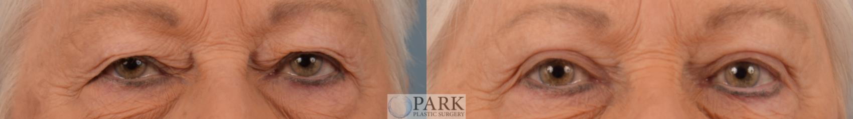 Before & After Blepharoplasty Case 64 Front View in Rocky Mount & Greenville, NC