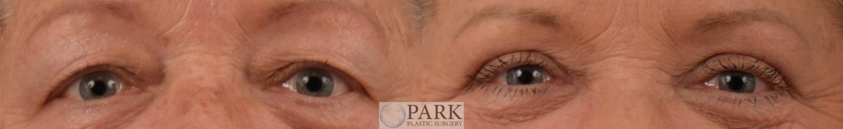Upper Blepharoplasty Before Surgery