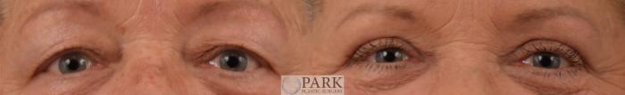 Upper Blepharoplasty Before Surgery