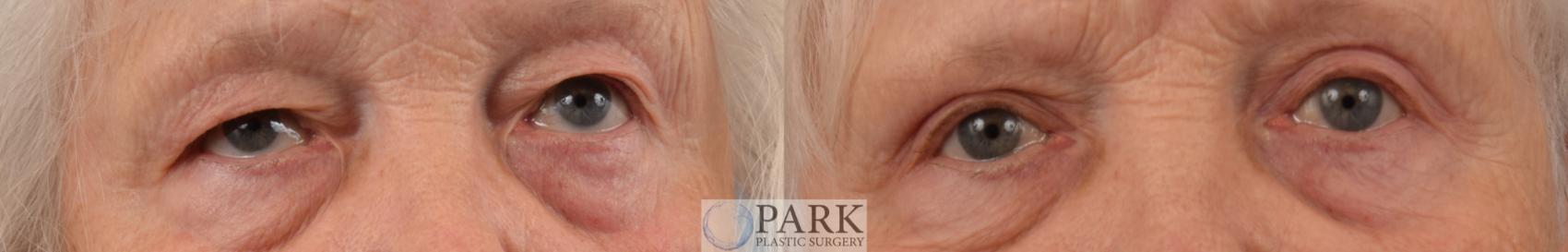 Before & After Blepharoplasty Case 80 Front View in Rocky Mount & Greenville, NC