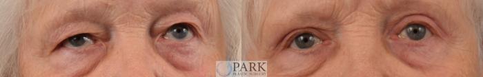 Before & After Blepharoplasty Case 80 Front View in Rocky Mount & Greenville, NC