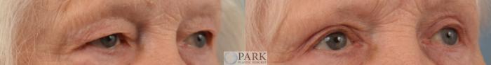 Before & After Blepharoplasty Case 80 Left Oblique View in Rocky Mount & Greenville, NC