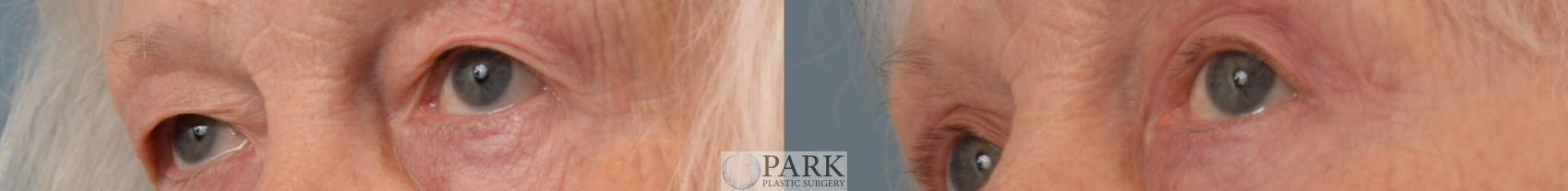 Before & After Blepharoplasty Case 80 Left Side View in Rocky Mount & Greenville, NC