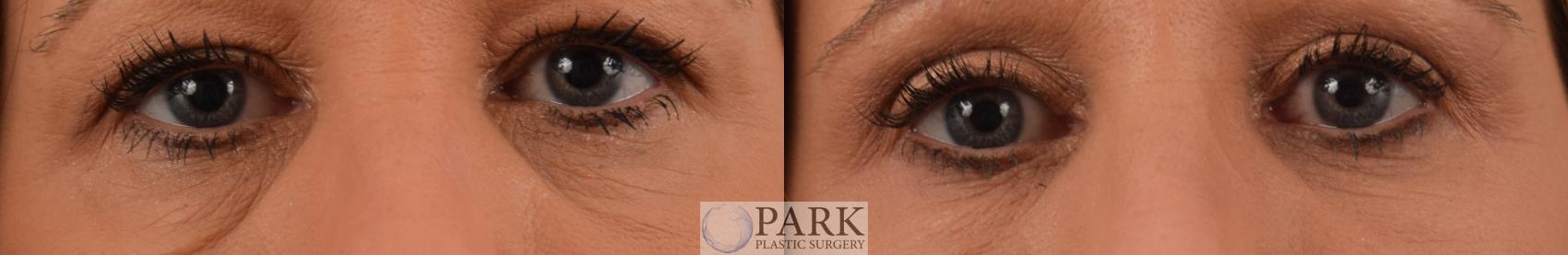 Upper and Lower Blepharoplasty Surgery With Under Eye Laser