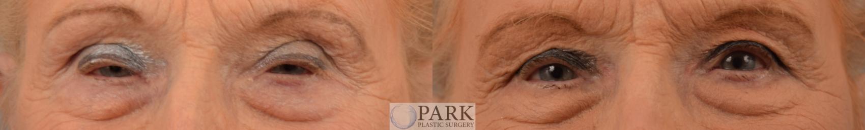 Insurance approved upper blepharoplasty