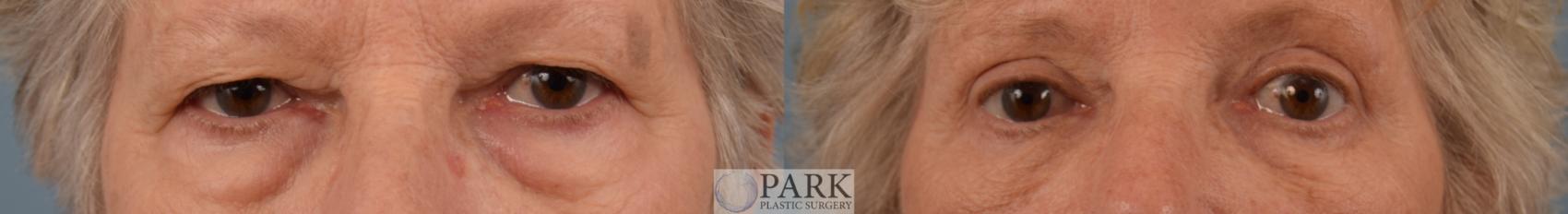 Upper and Lower Blepharoplasty Surgery
