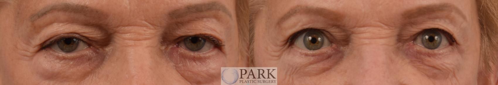 Before & After Blepharoplasty Case 90 Front View in Rocky Mount & Greenville, NC