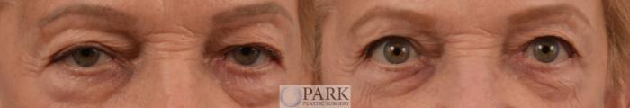 Before & After Blepharoplasty Case 90 Front View in Rocky Mount & Greenville, NC