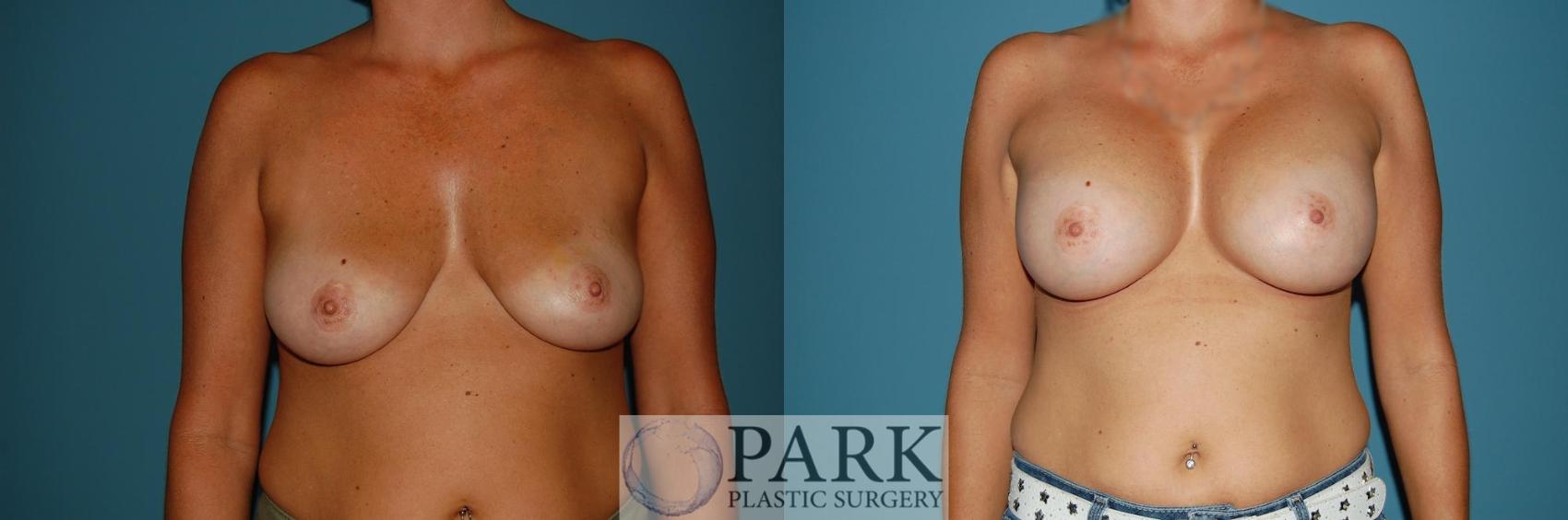 Before & After Breast Augmentation Case 40 Front View in Rocky Mount & Greenville, NC