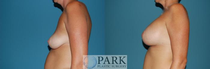 Before & After Breast Augmentation Case 40 Left Side View in Rocky Mount & Greenville, NC