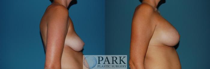 Before & After Breast Augmentation Case 40 Right Side View in Rocky Mount & Greenville, NC