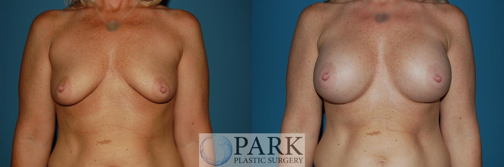 Before & After Breast Augmentation Case 41 Front View in Rocky Mount & Greenville, NC
