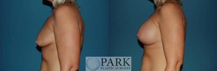 Before & After Breast Augmentation Case 41 Left Side View in Rocky Mount & Greenville, NC