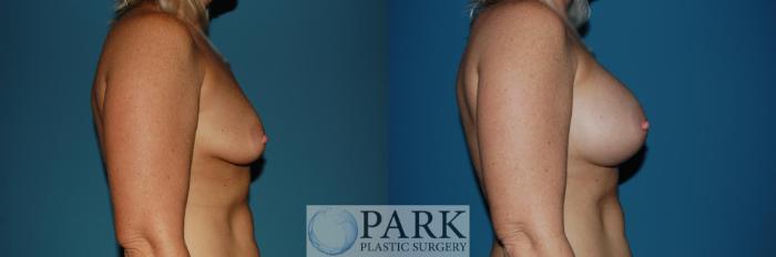 Before & After Breast Augmentation Case 41 Right Side View in Rocky Mount & Greenville, NC