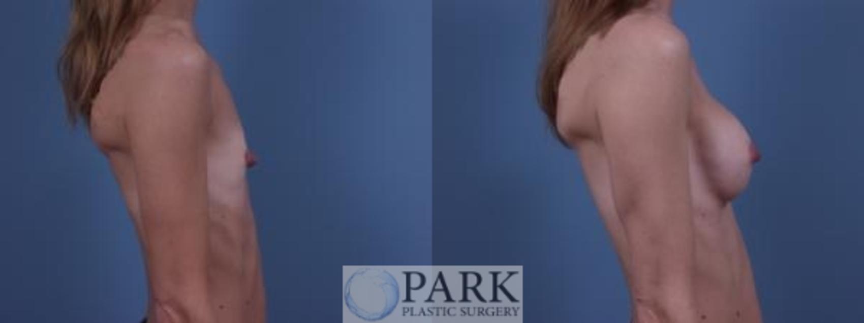 Before & After Breast Augmentation Case 42 Right Side View in Rocky Mount & Greenville, NC