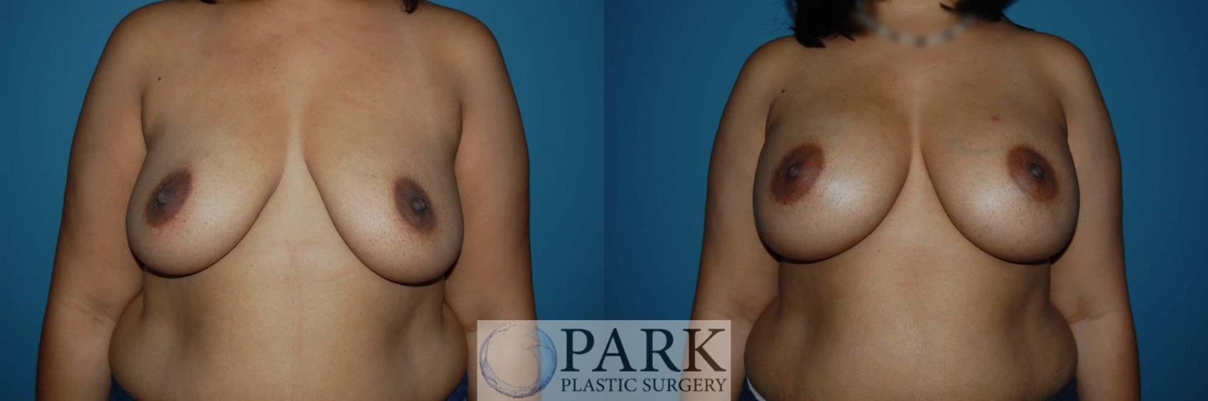 Before & After Breast Augmentation Case 43 Front View in Rocky Mount & Greenville, NC