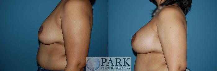 Before & After Breast Augmentation Case 43 Left Side View in Rocky Mount & Greenville, NC