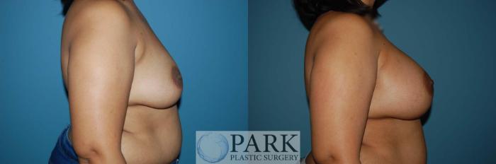 Before & After Breast Augmentation Case 43 Right Side View in Rocky Mount & Greenville, NC