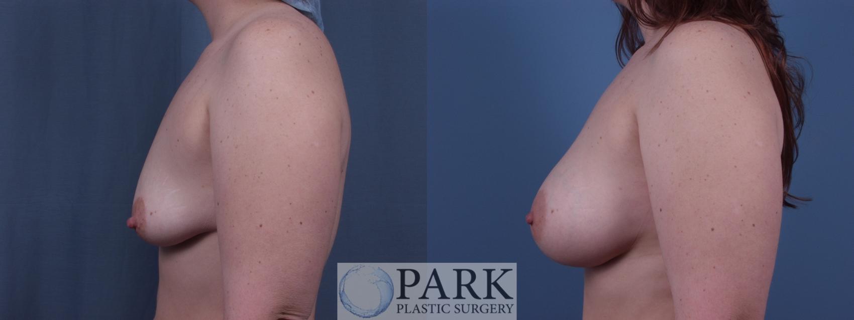 Before & After Breast Augmentation Case 44 Left Side View in Rocky Mount & Greenville, NC