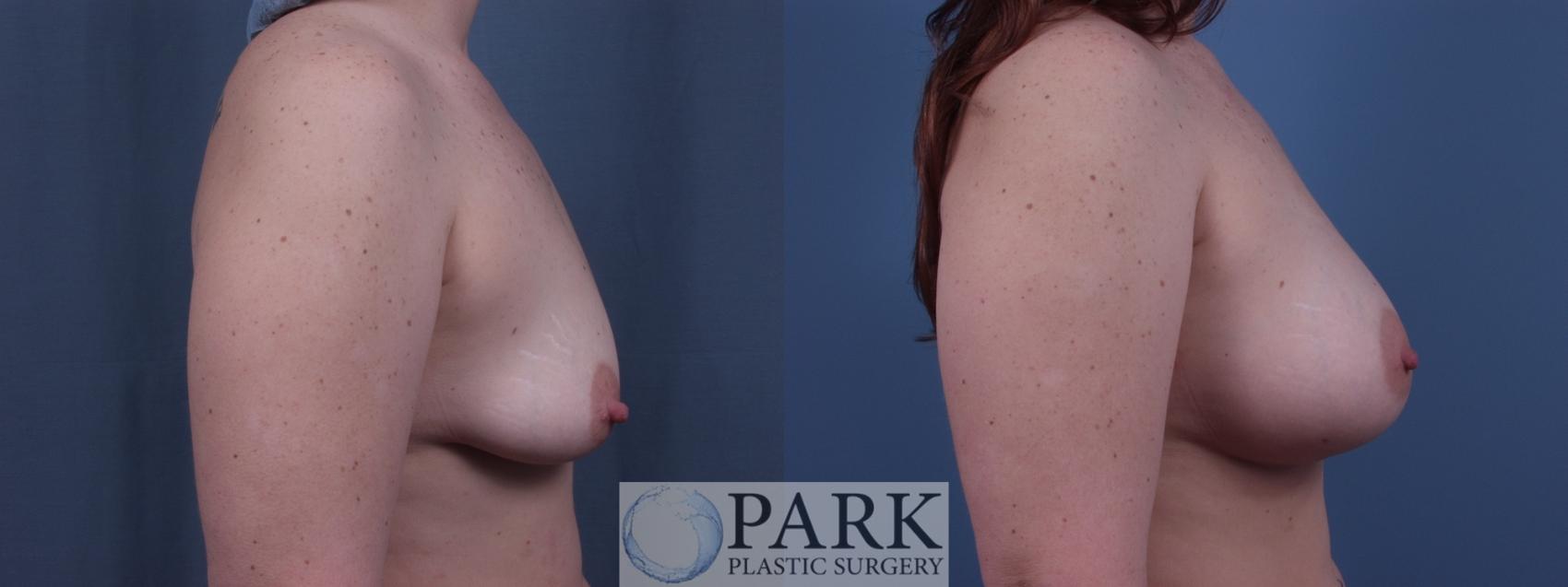 Before & After Breast Augmentation Case 44 Right Side View in Rocky Mount & Greenville, NC