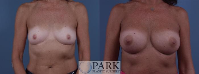 Before & After Breast Augmentation Case 45 Front View in Rocky Mount, NC